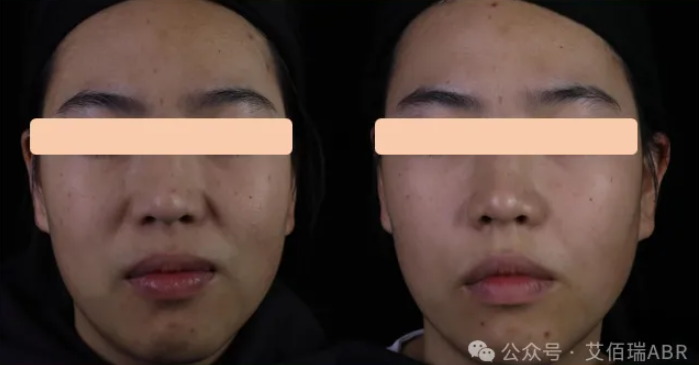 Domestic First-in-Class Achievement Headline: Subject Enrollment Successfully Completed for China’s First Natural Cross-Linked Collagen Fiber Filler (Type III)